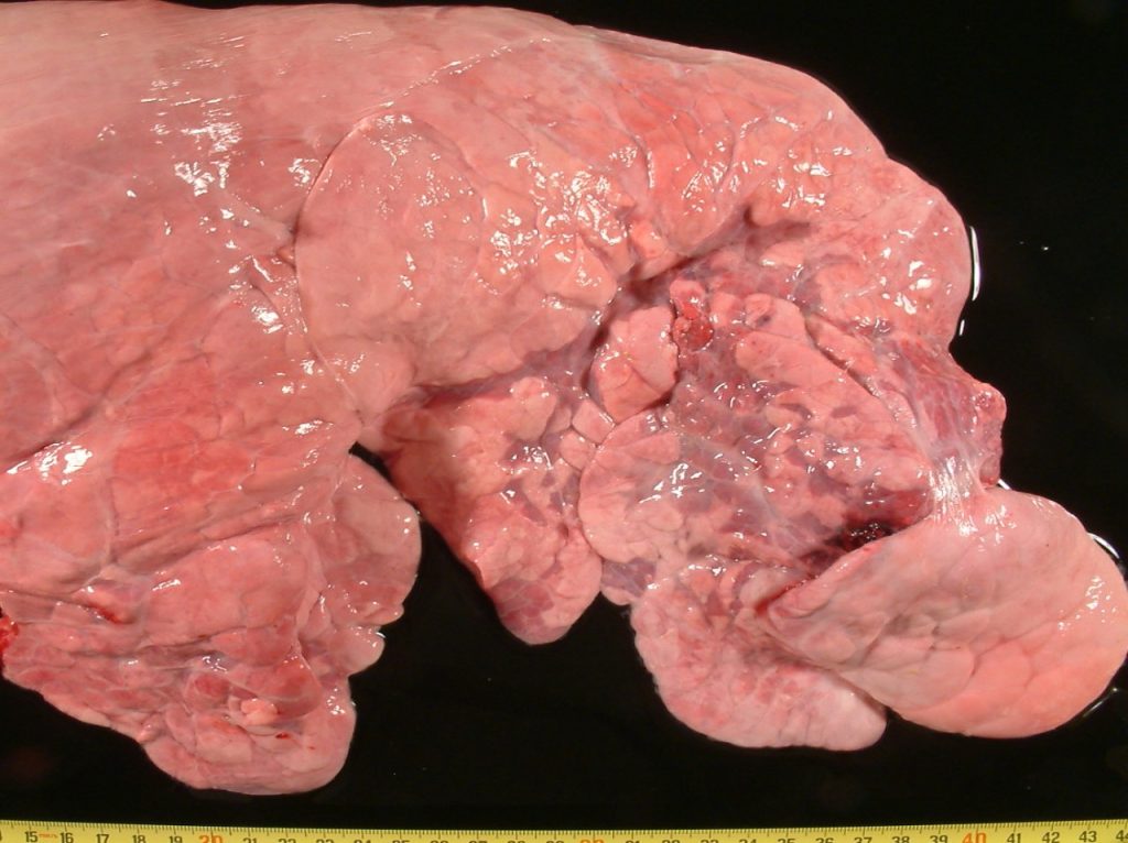 Fig. 5: Neumonía catarral purulenta, en fase de recuperación. Bandas de atelectasia, con enfisema alveolar.