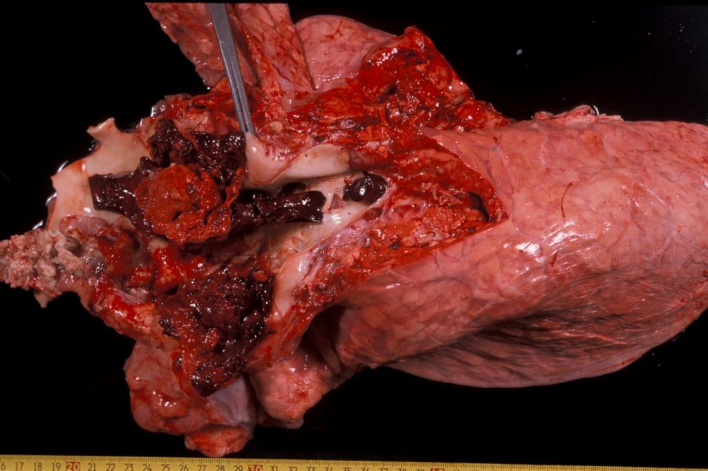 Fig. 6: Hemorragia tras la rotura de un vaso que sufría un aneurisma en un caso de síndrome de la vena cava.