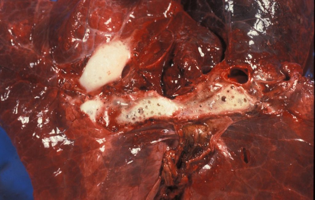 Fig. 9: Edema alveolar. Contenido espumoso en la luz de los bronquios.